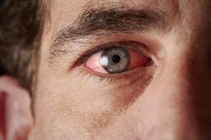 What to do about dry eye