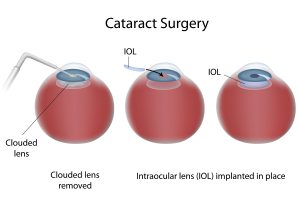 Cataract Surgery in Manhattan
