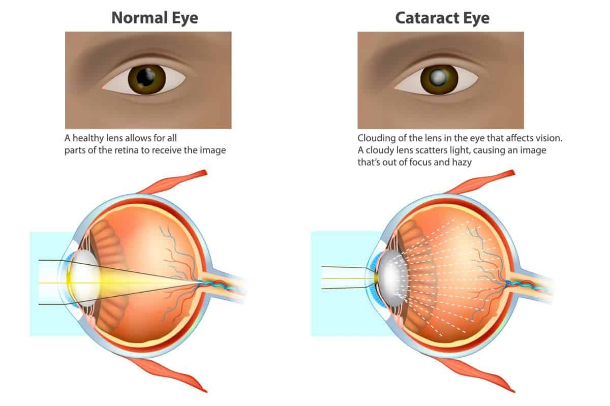 What Causes Halos Around Lights After Cataract Surgery Shelly Lighting