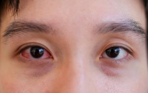 conjunctivitis